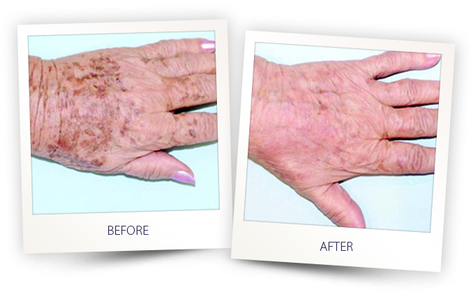 Before and after IPL treatment on hands — dramatic reduction in age spots and sun damage